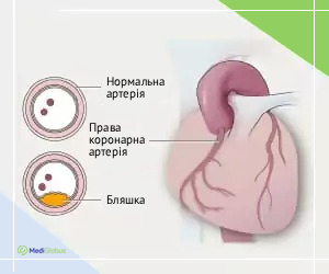 coronary_plaque_ukr Як виглядає ішемічна хвороюа серця