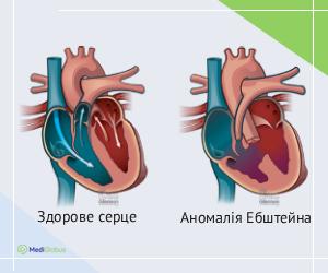 ebstein_anomaly_ukr Як виглядає аномаллія Ебштейна?