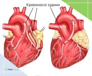 heart_shunting_ukr Аорто-коронарне шунтування ілюстрація операції