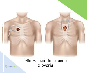 minimally_ivasive_ukr Мінімально-інвазивна операція на серці