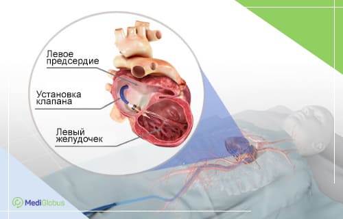 Новые подходы к операциям на клапанах сердца