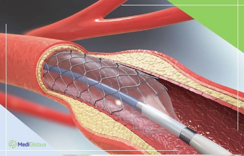 Modern vascular stents