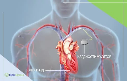 установка кардиостимулятора с помощью робота да винчи за рубежом