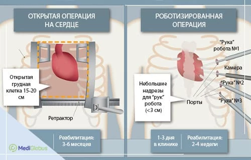 аортокоронарное шунтирование с роботом да винчи за рубежом