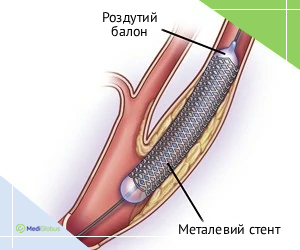 stenting_ukr Як виглядає стенування судин