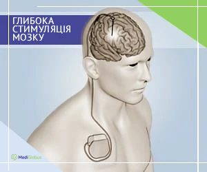 dbs_ukr Глибока стимуляція мозку для лікування есенціального тремору