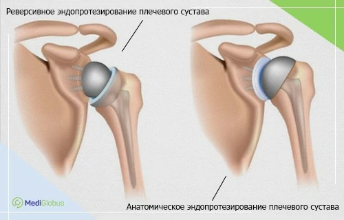 техники эндопротезирования плечевого сустава сравнение реверсивного и анатомического эндопротезирования плечевого сустава