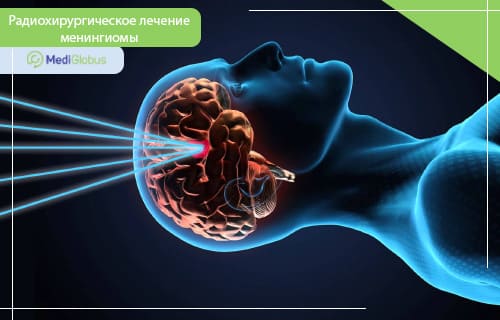 радиохирургическое лечение менингиомы мозга кибер-нож гамма-нож