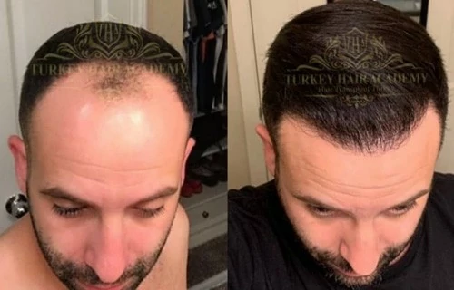 Клініка Turkey Hair Academy