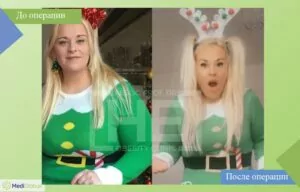фото до и после баллонирования желудка доктор эрдем