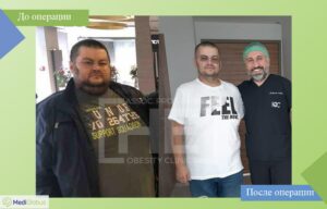 до и после шунтирования желудка фото доктор эрдем