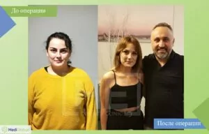 фото до и после рукавной резекции желудка доктор эрдем