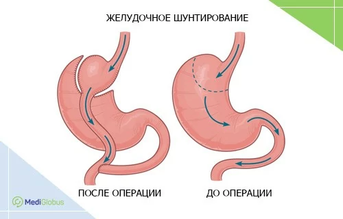 создание желудочного шунта