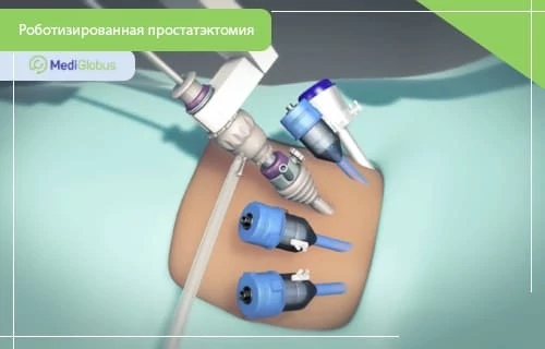 схема роботизированной простатэктомии с установленными портами и инструментами da Vinci