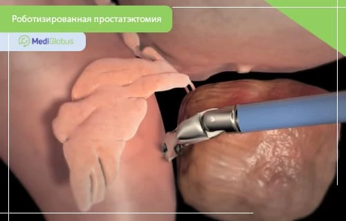 роботизированная простатэктомия проведение простатэктомии с помощью роботизированной хирургической установки