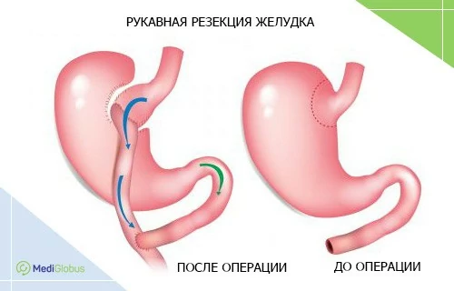 рукавная гастропластика