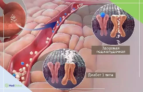 Стволовые клетки и сахарный диабет. Результат лечения Медицинская иллюстрация, показывающая сравнение здоровой поджелудочной железы и железы при диабете 1 типа