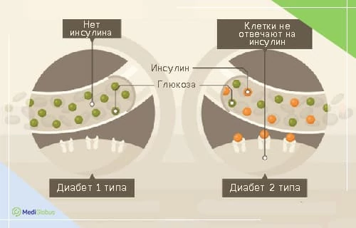 Лечение стволовыми клетками диабета 1 и 2 типа Медицинская схема, сравнивающая диабет 1 и 2 типа