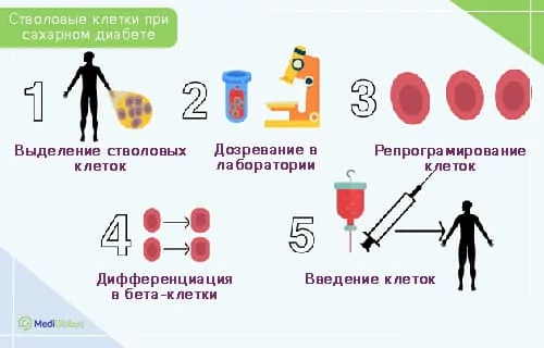 Стволовые клетки при диабете Инфографика, показывающая этапы применения стволовых клеток при сахарном диабете