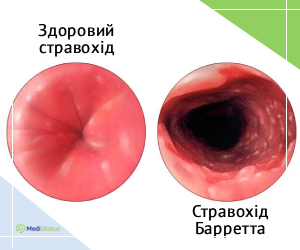 barretts_info_ukr Порівняння стравоходу Баррета та здорового стравоходу