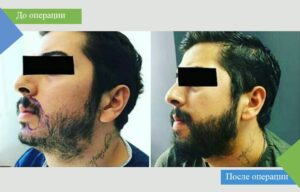 пересадка бороды до и после фото