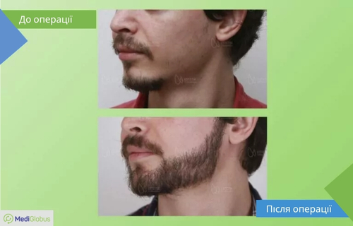 Фото до та після пересадки бороди в клініці Естетика Порівняння результатів до та після пересадки бороди в клініці Естетика