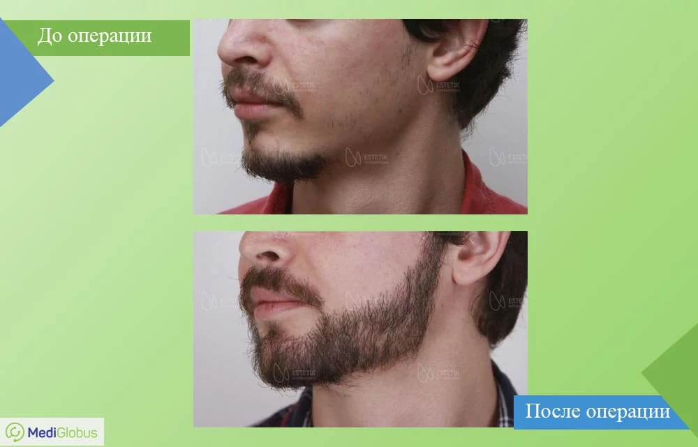 Фото до и после пересадки бороды в клинике Эстетика Сравнение результатов до/после пересадки бороды в клинике Эстетика