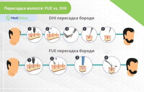 як роблять пересадку бороди за кордоном — порівняння методів FUE та DHI Інфографіка: Порівняння методів пересадки бороди FUE та DHI з етапами вилучення та імплантації фолікулів