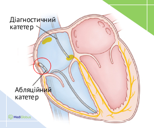 heartablation_info_ukr Як працює радіочастотна абляція серця схема