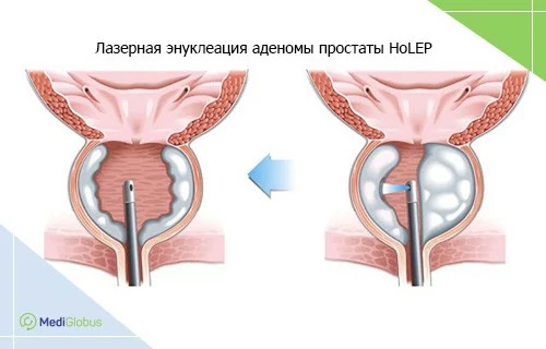 HoLEP при аденоме простаты