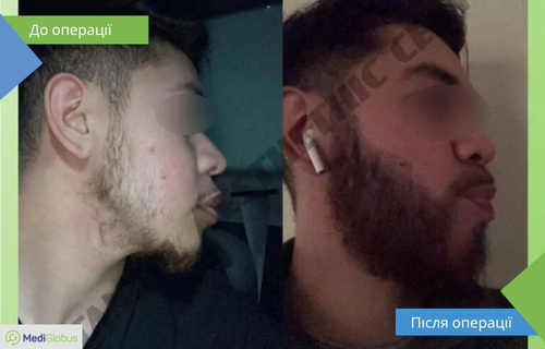 Фото до та після пересадки бороди в клініці Істанбул Естетик Порівняння результатів до та після пересадки бороди в клініці Істанбул Естетик