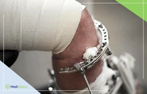 стволовые клетки в заболевании суставов