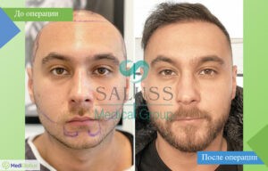 пересадка бороды до и после фото