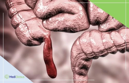 Рак аппендикса на 2-3 стадии Изображение толстой кишки человека с воспаленным аппендиксом.