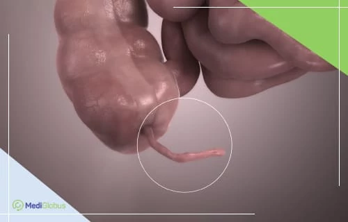 Что такое рак аппендикса 3D-изображение фрагмента толстой кишки человека с аппендиксом