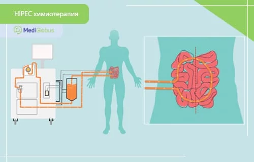HIPEC-химиотерапия при раке аппендикса Схема проведения HIPEC-химиотерапии