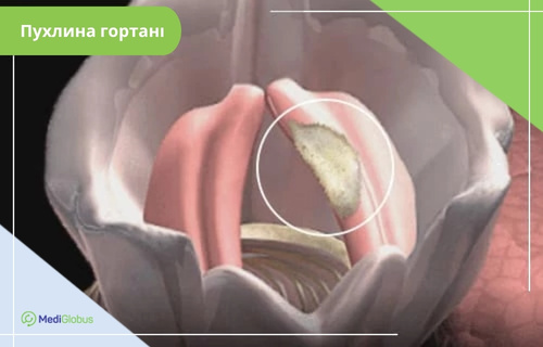 3D-візуалізація гортані з голосовими зв’язками та пухлиною на одній із зв’язок