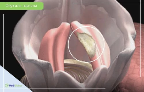 3D-визуализация гортани с голосовыми связками и опухолью на одной из связок