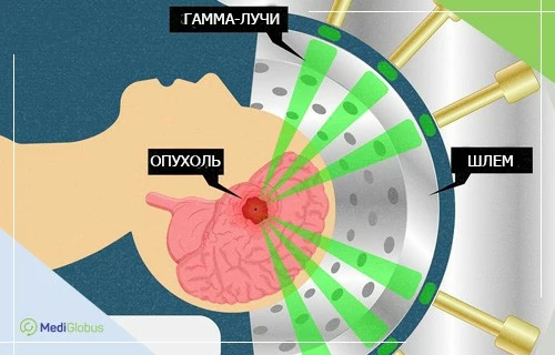 Лечение внутримозговых метастазов схема радиохирургии Gamma Knife — гамма-лучи фокусируются на опухоли в головном мозге