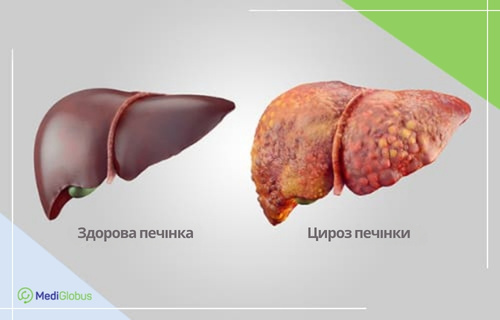 Що таке цироз печінки Порівняння здорової печінки і печінки при цирозі
