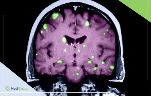 метастазы в головном мозге