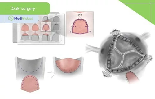 ozaki-surgery-technique-eng ozaki surgery technique