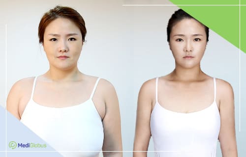 Уменьшение и подтяжка груди фото до и после