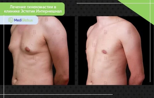 Результаты хирургического уменьшения груди в Турции Цена на уменьшение груди в Турции и где проводить операцию