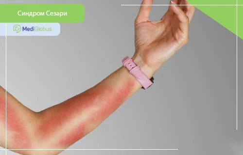 Симптомы синдрома Сезари — кожные проявления и покраснение кожи рука с покраснением кожи и воспаленными участками