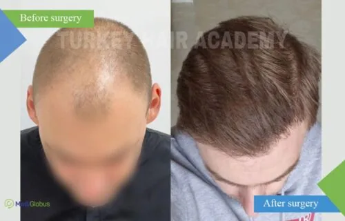 turkey-hair-academy-hair-treansplant-before-after-1-eng turkey-hair-academy-hair-treansplant-before-after-1-eng