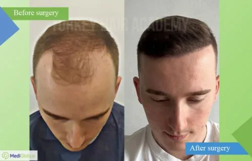 turkey-hair-academy-hair-treansplant-before-after-2-eng turkey-hair-academy-hair-treansplant-before-after-2-eng