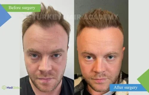 turkey-hair-academy-hair-treansplant-before-after-3-eng turkey-hair-academy-hair-treansplant-before-after-3-eng