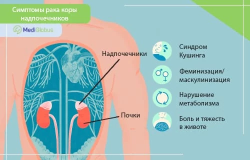 симптомы рака надпочечников схематическое изображение внутренних органов с выделенными почками и надпочечниками и симптомами рака коры надпочечников
