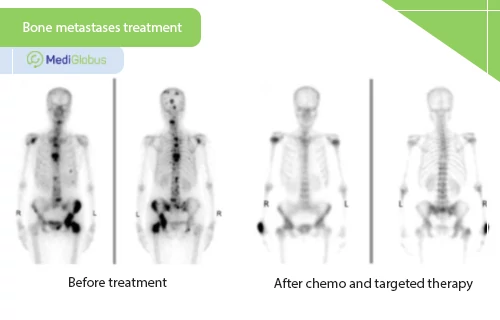 Management of bone metastases of unknown primary